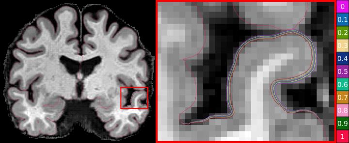 CSIRO researchers use machine learning to advance Alzheimer’s research. Credit: CSIRO